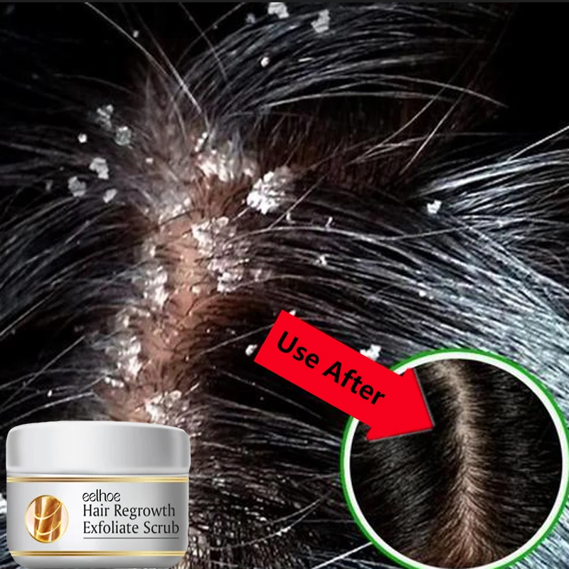 Fast Anti Dandruff Hair Treatm - Scalp Scrub Exfoliant ulasan dan harga