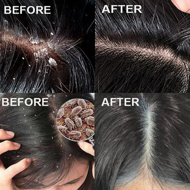 Fast Anti Dandruff Hair Treatm - Scalp Scrub Exfoliant ulasan dan harga