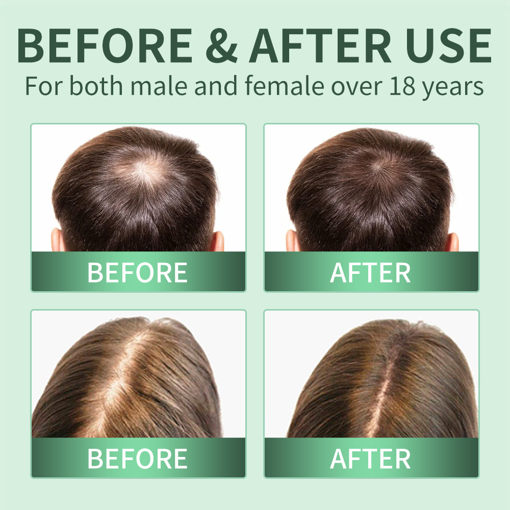 Hair Growth Spray,Scalp Scrub, - Scalp Scrub Exfoliant ulasan dan harga